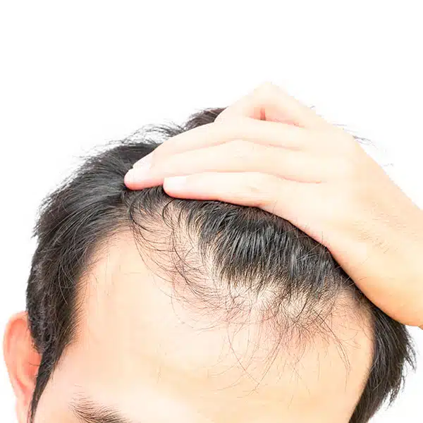 Пересадка волос в Турции методом DHI — золотой стандарт сегодняшнего времени